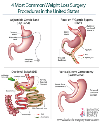 types of bariatric surgery