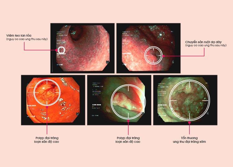 Một số hình ảnh tổn thương được ghi nhận qua nội soi tầm soát ung thư đường tiêu hóa